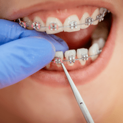 Sonrisa mostrando Brackets