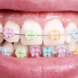 Ligas de brackets de colores