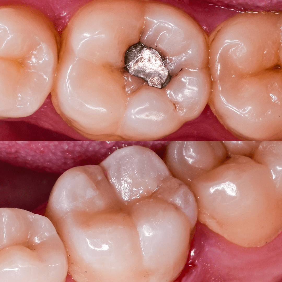 Reconstuccion Dental con Resinas