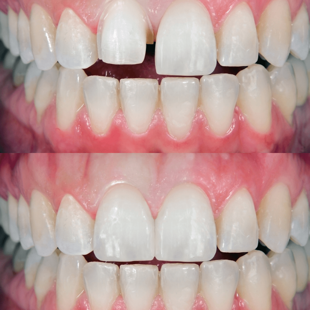 Coronas de Zirconia