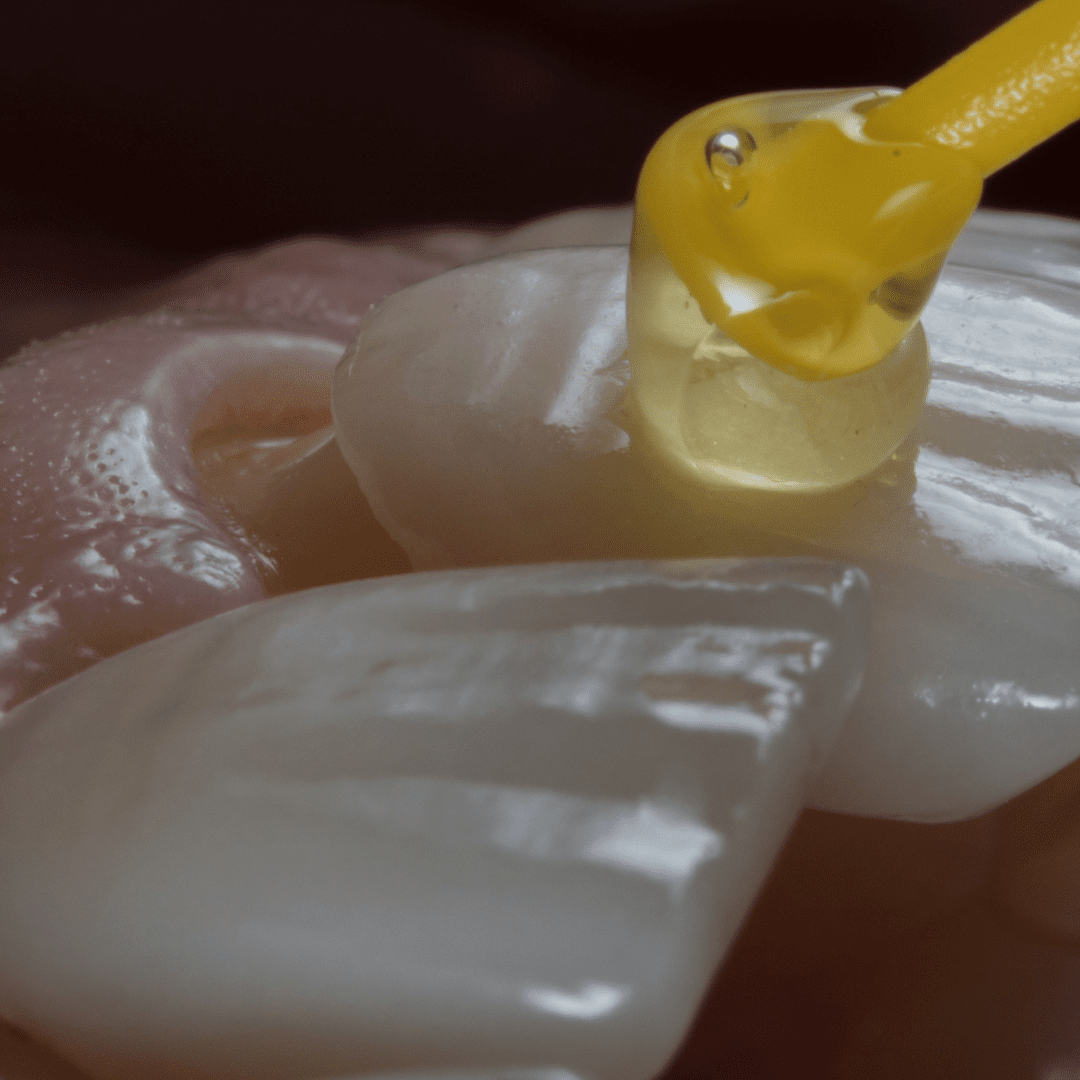 Carillas Dentales o Veneers